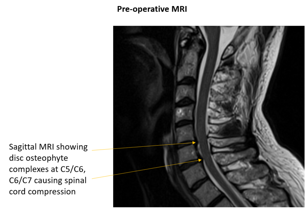 ACDF Surgery for Back Pain | Cleveland Spine Center